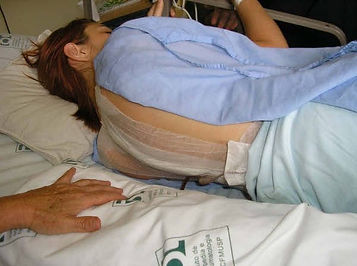 aline's backs with a 30cm wound dressing. she is laying down on a hospital bed just after her surgery