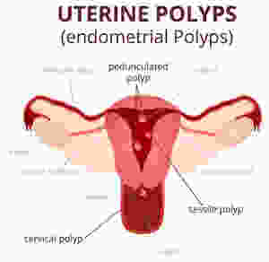 How long does it take to recover from uterine polyp removal? Is it painful to have polyps removed? Do polyps in the uterus need to be removed? What are the symptoms of polyps in the uterus? uterine polyp removal recovery time; uterine polyp removal post op; uterine polyp removal without anesthesia; what to expect after uterine polyp removal; do uterine polyps need to be removed; endometrial polyp removal side effects; uterine polyps treatment;
