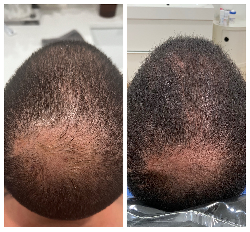 PRP Hair Growth Restoration Miami Allopecia Spa Medspa Near Me