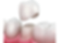 dental-crowns-kamloops.png