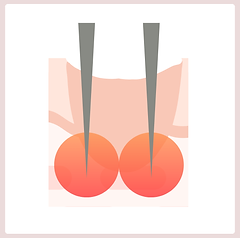 ニードル高周波