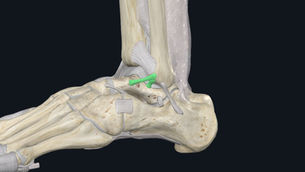 Get Back in the Game: Effective Lateral Ankle Sprain Rehabilitation for Athletes