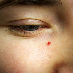 angioma.jpeg