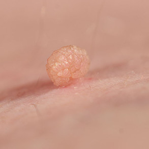 skintag-968350914-770x533-1.jpeg