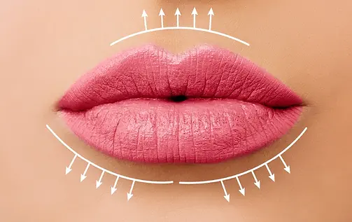 What-are-Lip-Fillers