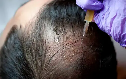 prp for hair