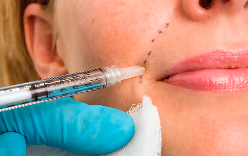 dermal_fillers_