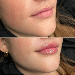 Dermal Fille Results - Lip Filler Plymouth.png