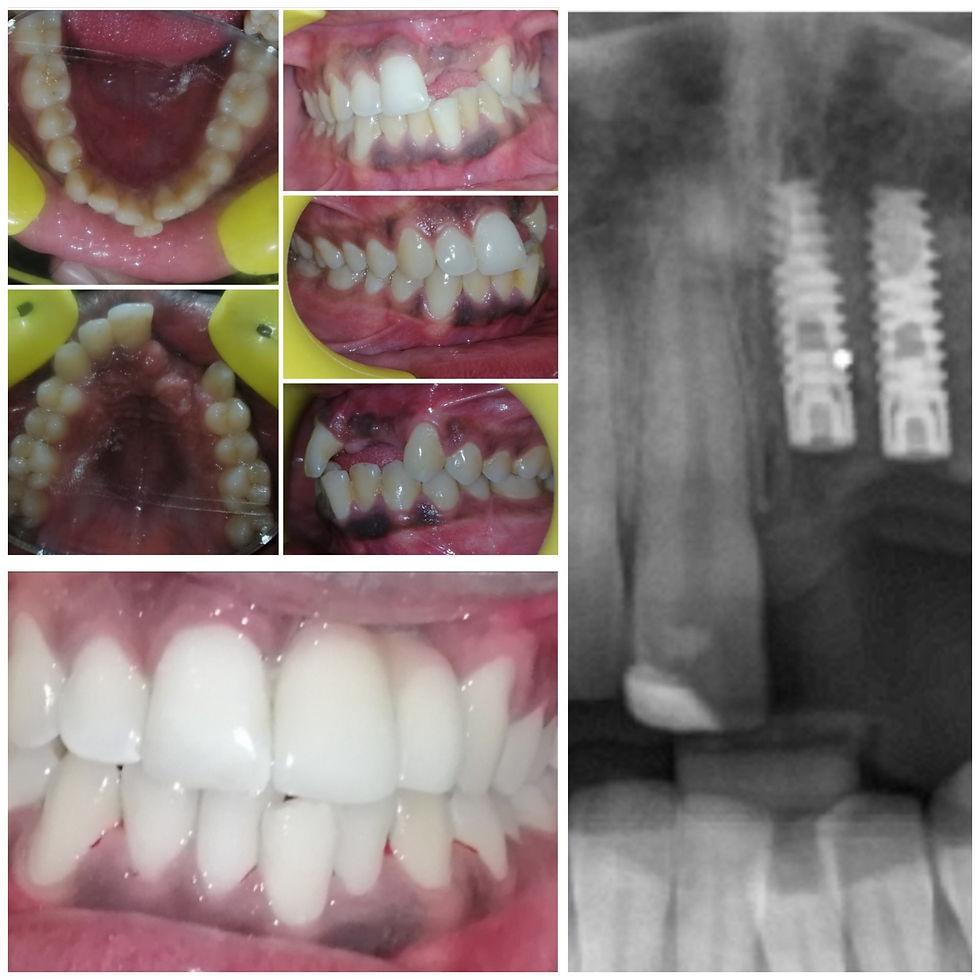 Implant Supported Teeth After Bone Grafting