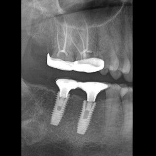 Root canal Treatment and Crowns