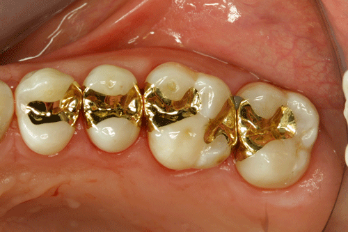 gold_inlay