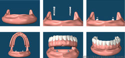 implant-supported-overdenture2