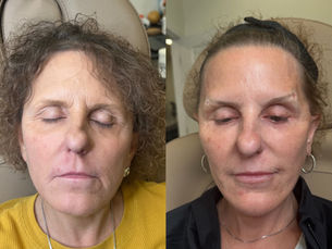 A Complete Facial Transformation Through Non-Surgical Aesthetic Treatments
