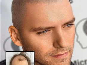 SCALP MICROPIGMENTATION 