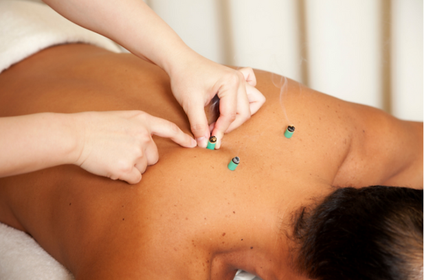 Acupuncturist applying Moxibustion Therapy to patient.
