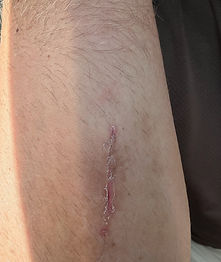 Arm pump incision 10 days post op