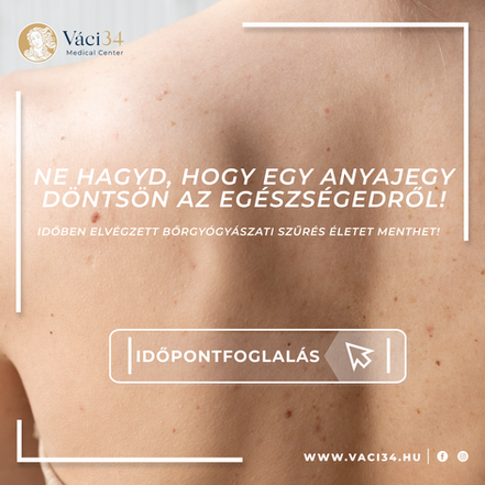 Ne napozz anyajegyszűrés nélkül! – A bőröd hálás lesz érte