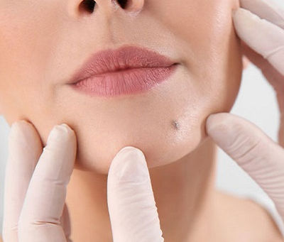 The Most Effective Method to Pick the Right Mole Removal Treatment in Dubai