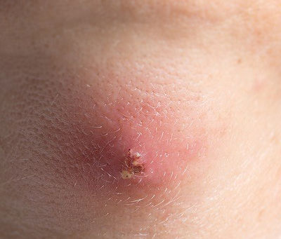 Painless Procedures: Incision and Drainage of Abscesses in Dubai