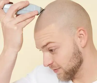 Dubai's Hair Renaissance: The Game-Changer – Scalp Micropigmentation