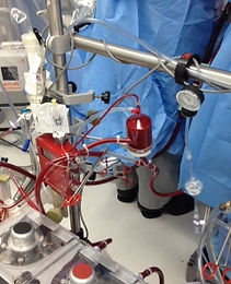 Heart Lung Bypass oxygenator and arterial filter under investigation