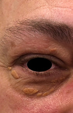 xanthélasma traitement plexr