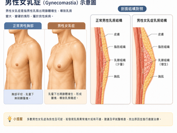 男性乳房比較大——談談男性女乳症