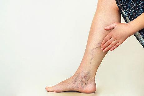 bigstock-varices.jpeg