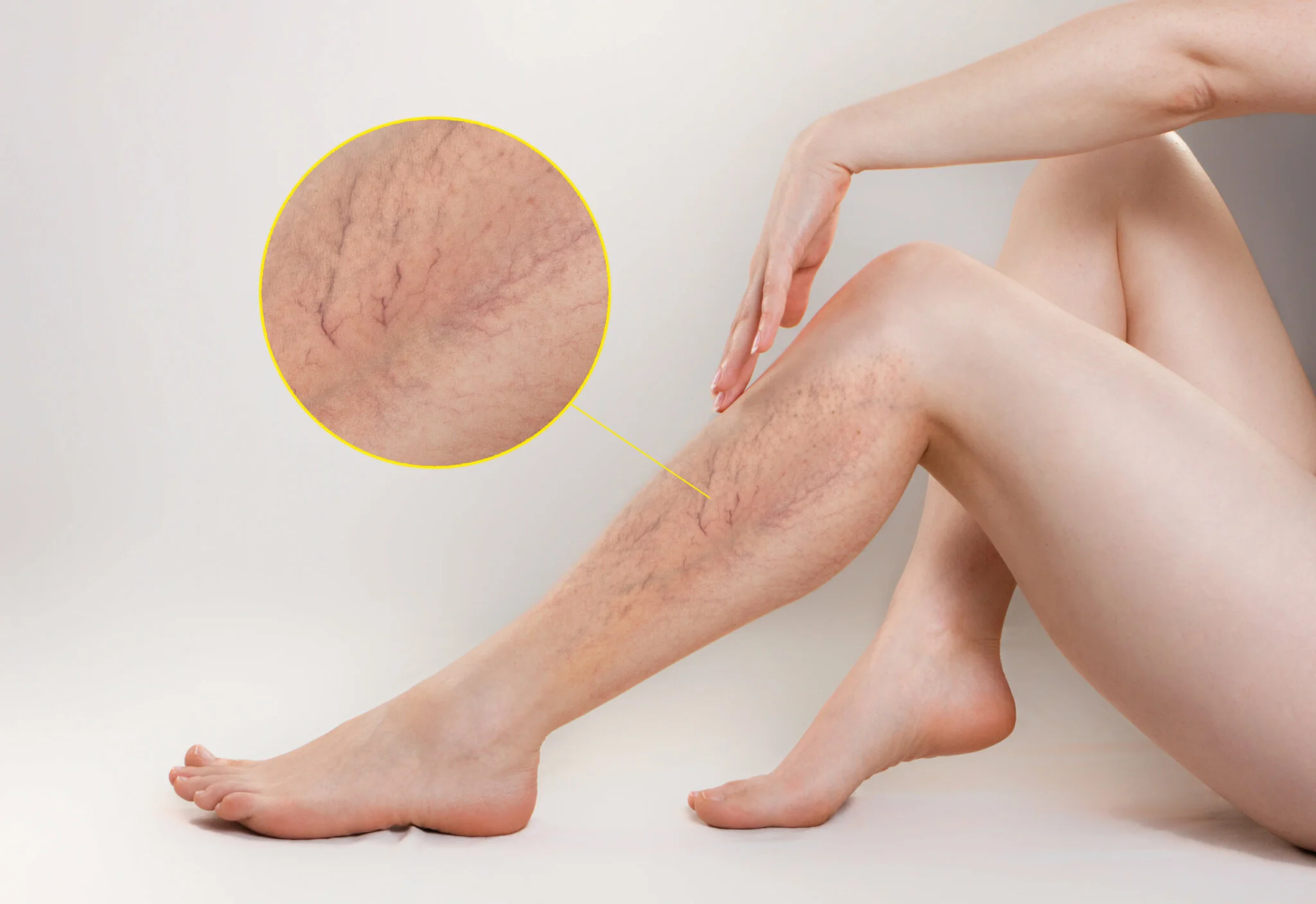 mujer-piernas-varices-manos-2048x1406.webp