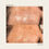 Thumbnail: epidermal melasma