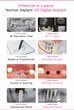 Dentist in Richardson Texas explains the purpose of a dental implant