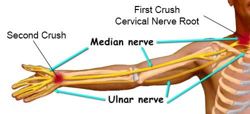 carpal tunnel