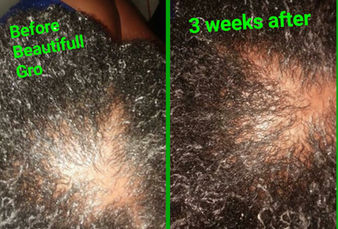 natural hair growth products Before After