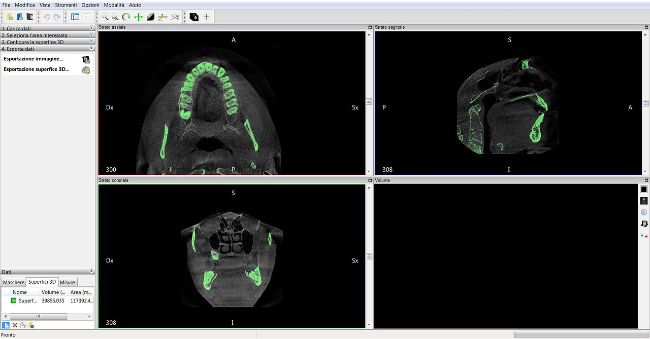 Processo di segmnetazione 3D del mascellare superiore - viste assiale, sagittale e coronale