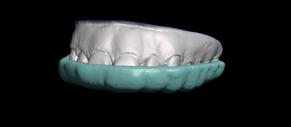 Realizzare bite con il software free "BlueSkyPlan"