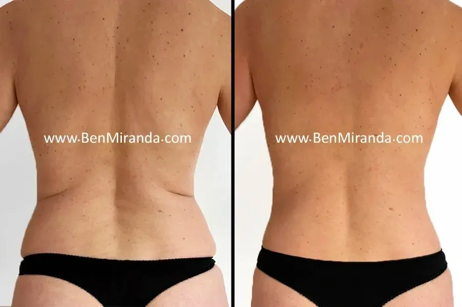 Before and after imagery of Fat Transfer Surgery and Liposuction in London and Essex