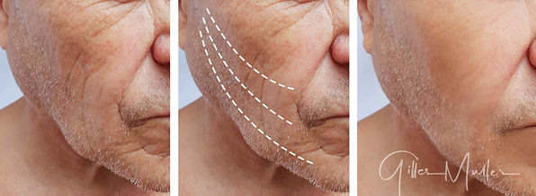 Affaissement homme | Avant et après | Æsthetic LIFT médical PRO