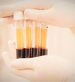 Platelet-Rich-PlasmaSmall_edited.jpg