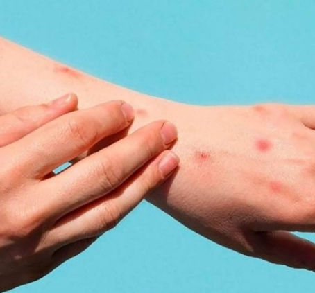 MÉXICO REBASA LOS 3 MIL CASOS DE VIRUELA DEL MONO; MICHOACÁN CONTABILIZA SIETE