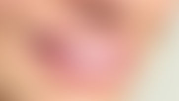 Erpes labiale cura naturale.