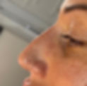 Nose Rhinoplasty