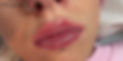 Lip Fillers