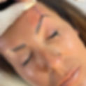 PDO Brow Lift
