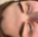 Facial Line Softening