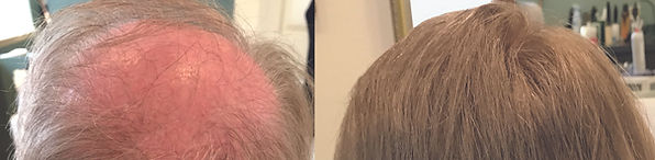 hair replacement for men danvers ma 