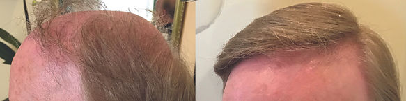 hair replacement for men cambridge ma