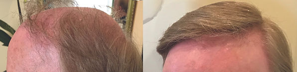 hair replacement for men dunstable 