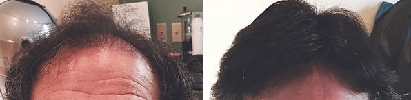 men's hair replacement chestnut hill ma