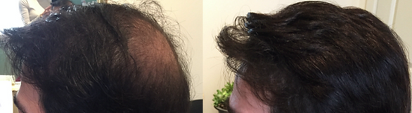 hair replacement systems brimfield ma