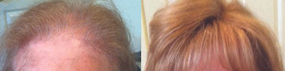 hair replacement systems brighton ma